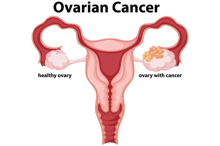 Screening Ovarian Cancer - Lifeline Laboratory