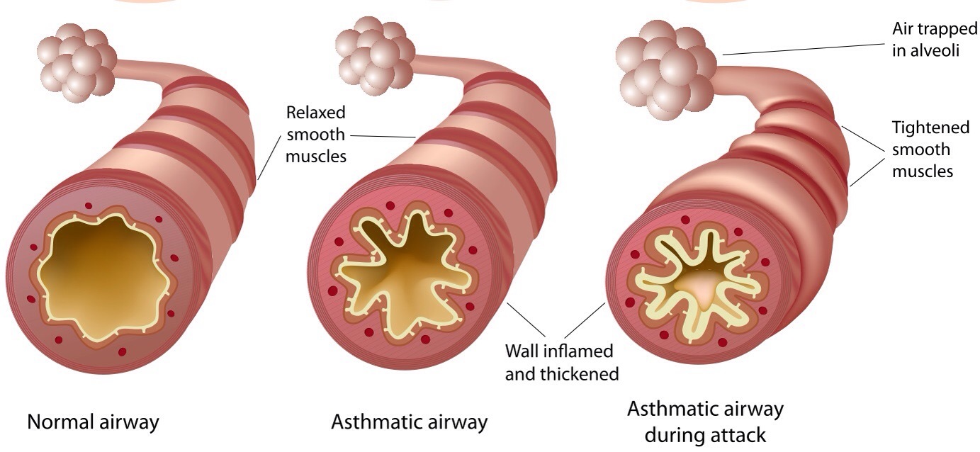 Asthma Diagnosis - Lifeline Laboratory