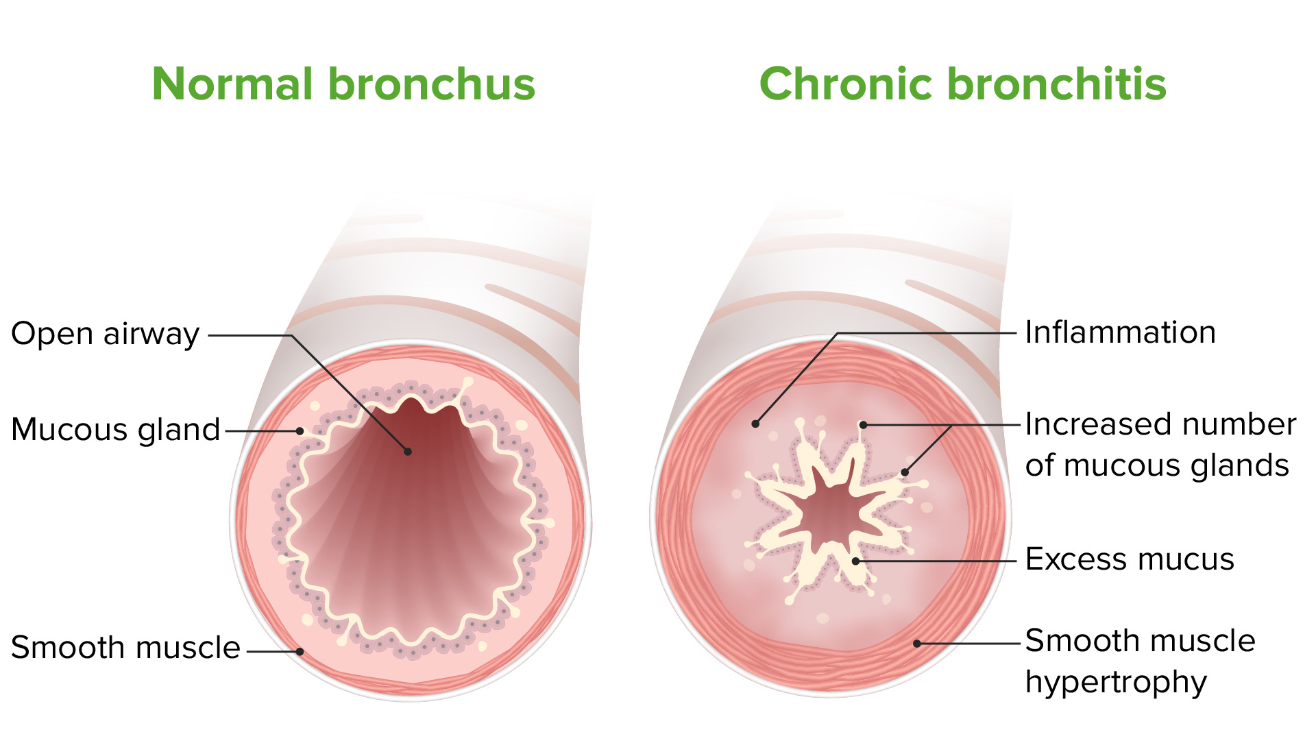 causes of blood in mucus