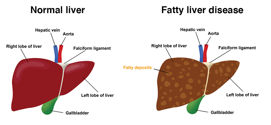 Fatty Liver Lifeline Laboratory