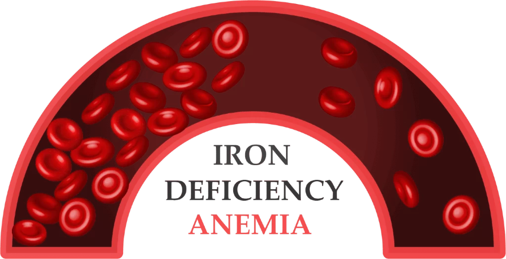 Using Soluble Transferrin Receptor (sTfR) and the sTfR/log ferritin